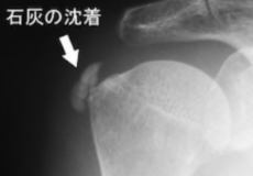 四十肩・五十肩の石灰化について